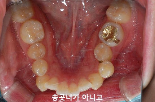 덧니교정과정, 4가지 요점만 알고 시작하세요! 관련 이미지 11