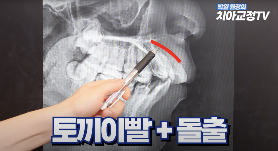강남역 교정치과 토끼 이빨 교정해야할까? 관련 이미지 5