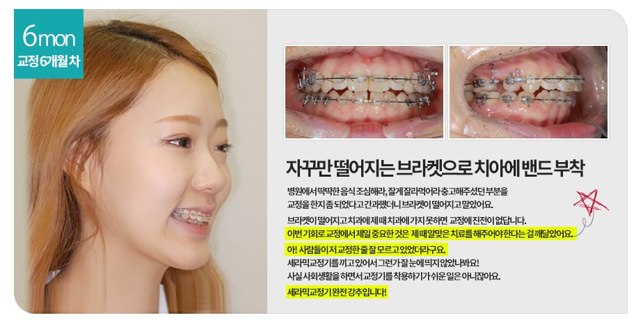 [돌출입교정전후] 앞니돌출교정사례 관련 이미지 3