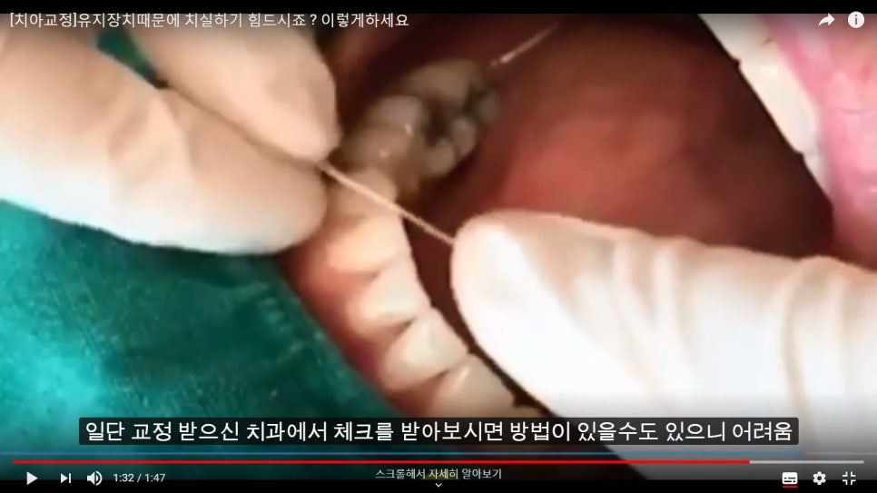 [치아교정] 고정식유지장치하고 있는 분들 보세요. 치실사용법 알려드려요!! 관련 이미지 3