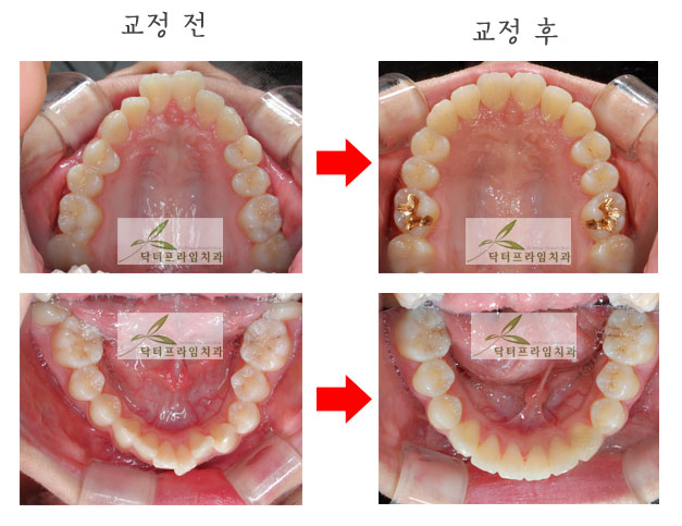 [토끼이빨교정후기] 토끼이빨교정은 나이가 어릴수록 교정기간은 짧아지고 비발치가능성은 높아지고... 관련 이미지 2
