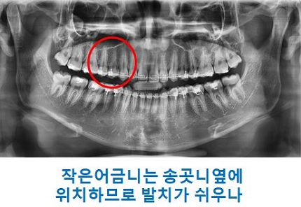 교정시작을 망설이게 하는 치아교정통증(1) 관련 이미지 10