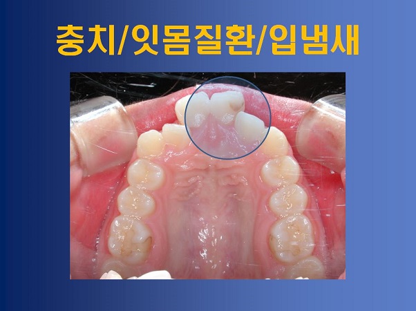 성장기 부정교합 방치했을때의 부작용! 관련 이미지 1