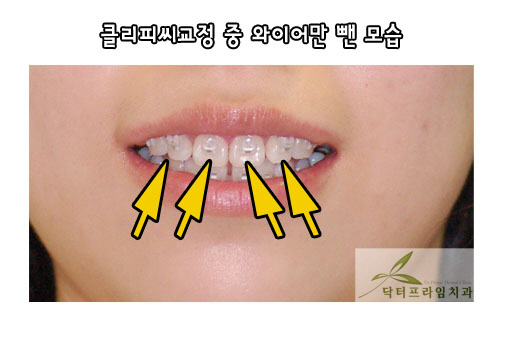 치아교정중 면접: 철사만 며칠 빼고~ 관련 이미지 3