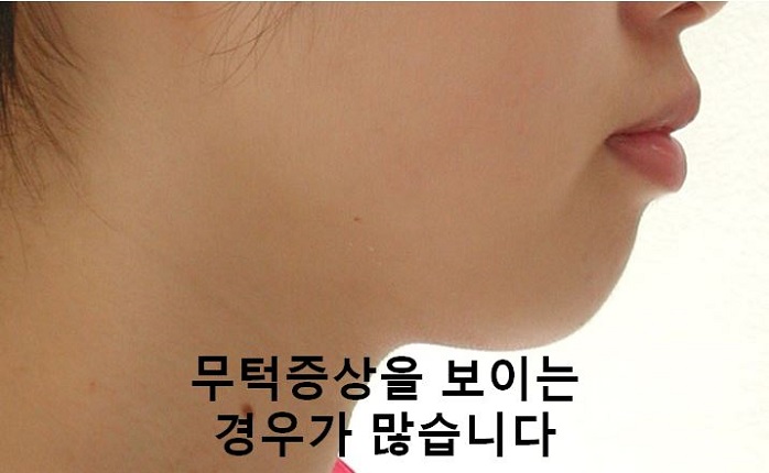 돌출입교정의 효과적인 시기! 관련 이미지 7