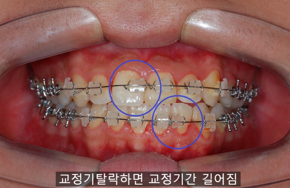 치아교정기간 짧아지는 방법 6가지! 관련 이미지 14