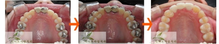 [치아교정후기] 앞니크라운 있는 경우의 치아교정전후 관련 이미지 4