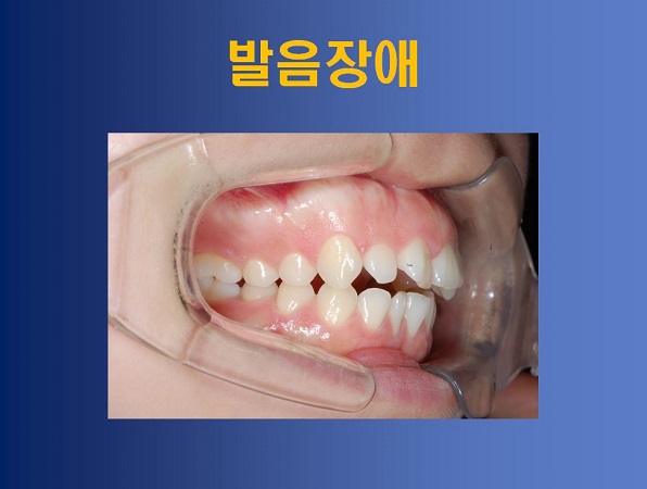 성장기 부정교합 방치했을때의 부작용! 관련 이미지 9