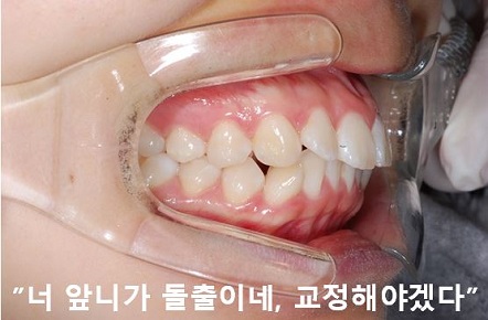 돌출입교정에 성공하는 방법 3가지! 관련 이미지 3