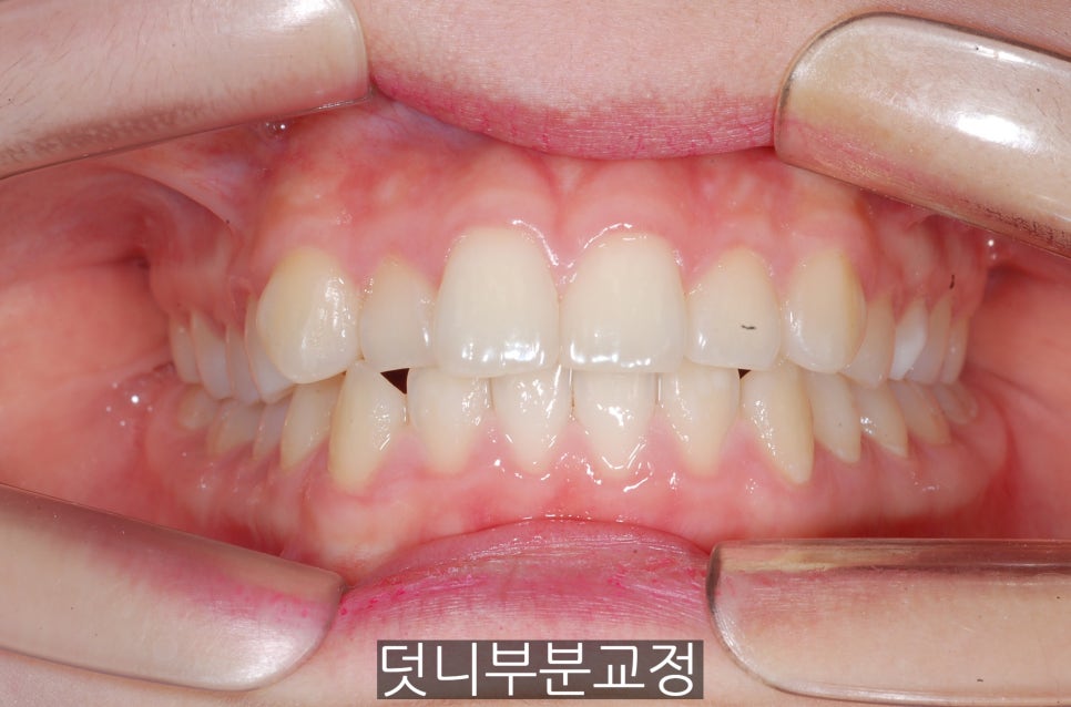 덧니부분교정하신 분들, 만족하시나요?? 관련 이미지 5