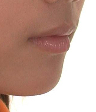 [치아교정과 발치교정]  돌출입,덧니의 발치교정과 통증 관련 이미지 1