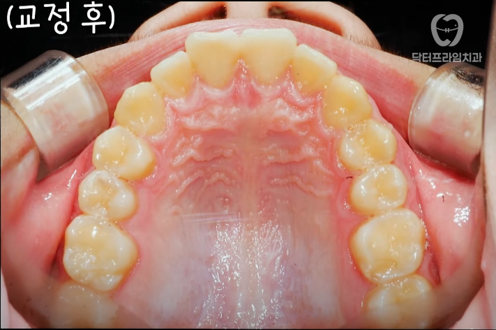 Facial asymmetry turns out to be caused by tooth alignment—can be improved with orthodontics! image 11
