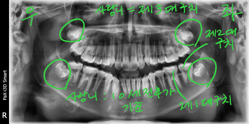 사랑니발치 절대 미루면 안되는 이유!(중고등학생) 관련 이미지 2
