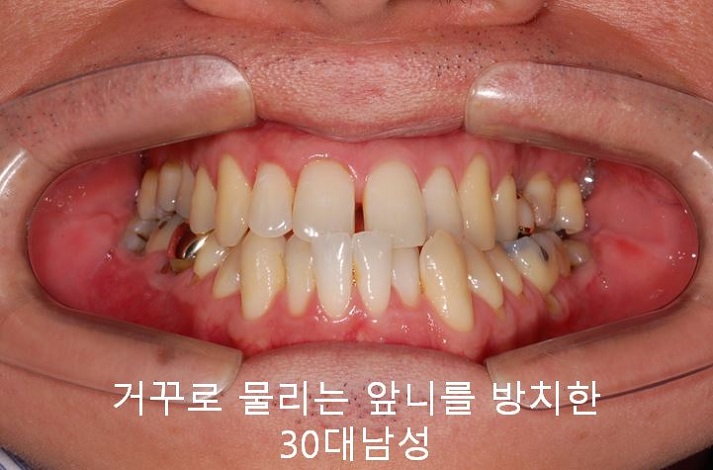 치아교정) 유지장치는 평생 해야 한다? 관련 이미지 11
