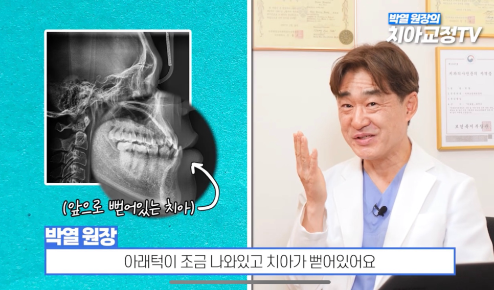 Can Adult Crossbite Be Treated With Orthodontic Dental Care? image 18