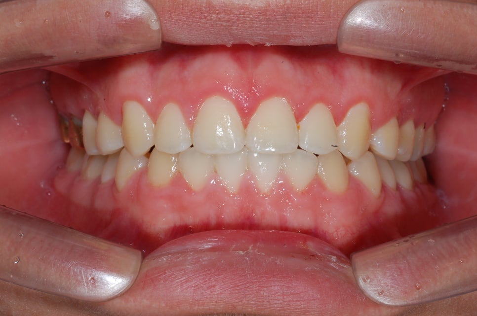 앞니틈새교정+잇몸성형 관련 이미지 4