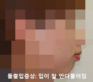 돌출입교정에 성공하는 방법 3가지! 관련 이미지 2