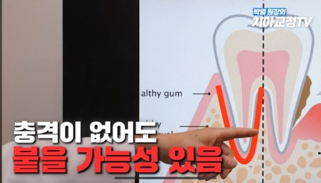 강남역치아교정, 신경치료 받은 치아도 교정이 될까? 관련 이미지 18
