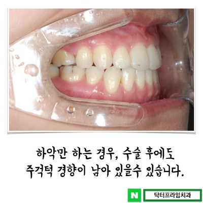 주걱턱교정 치료 보통은 양악수술 보다 하악을 먼저 생각 하지만… 관련 이미지 4