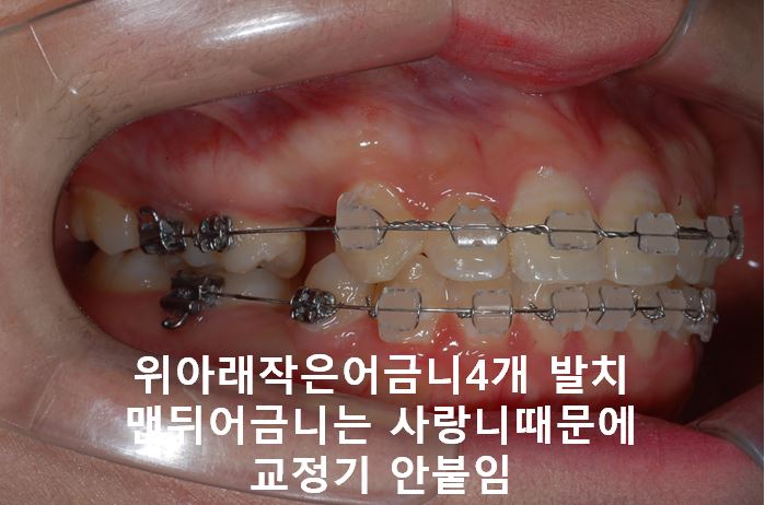 강남역돌출입교정, 옥니방지비법!! 관련 이미지 3