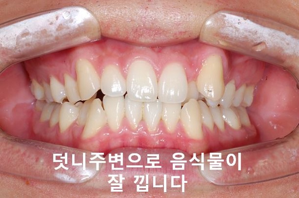 청소년, 덧니교정 안하면 이렇게 된다! 관련 이미지 2