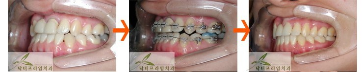[치아교정후기] 앞니크라운 있는 경우의 치아교정전후 관련 이미지 3