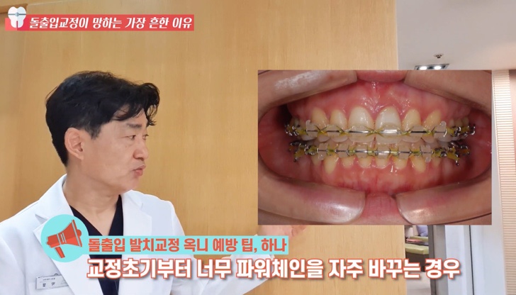 돌출입 교정치과 옥니 돌출입 치아 교정 왜 망할까? 관련 이미지 17