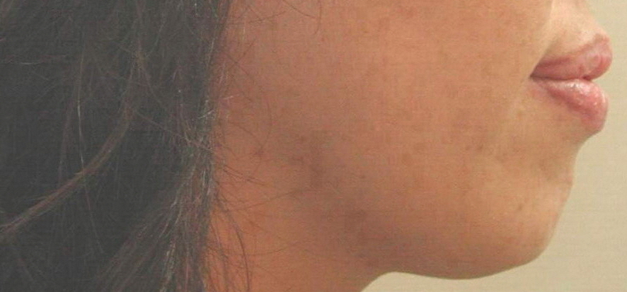 [돌출입교정] 30대후반여성 돌출입교정후기/전후사진. 돌출입+코끝모양+무턱개선 (앞니각도,입술모양,무턱개선) 관련 이미지 1