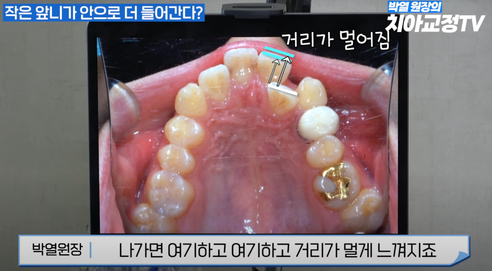 강남역 교정치과 :: 앞니 교정 시작 전에 꼭 알아야 할 한 가지 사실! 관련 이미지 11