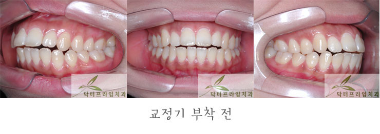 [치아교정후기] 30대 돌출입교정전후와 후기 관련 이미지 1
