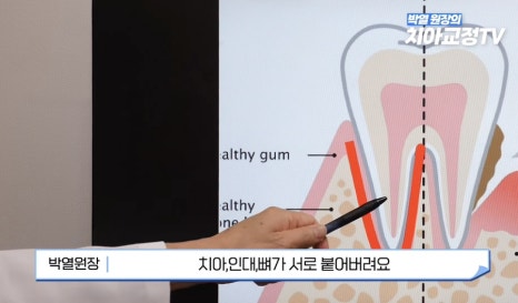 강남역치아교정, 신경치료 받은 치아도 교정이 될까? 관련 이미지 15
