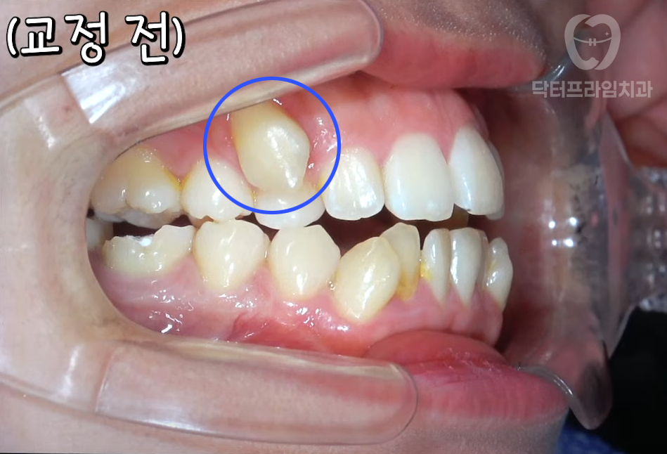 교정하면 잇몸 내려앉는다? 사실일까요, 괴담일까요? 관련 이미지 2
