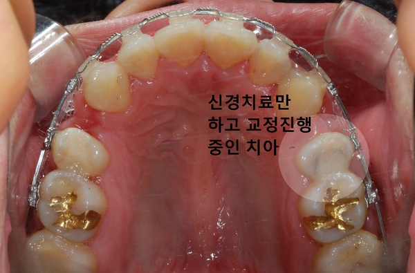 교정시작하려는데 충치치료를 먼저 해야하나요? 관련 이미지 2