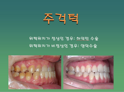 [치아교정] 하악수술과 양악수술을 나누는 진단기준 관련 이미지 2