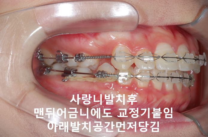 강남역돌출입교정, 옥니방지비법!! 관련 이미지 4