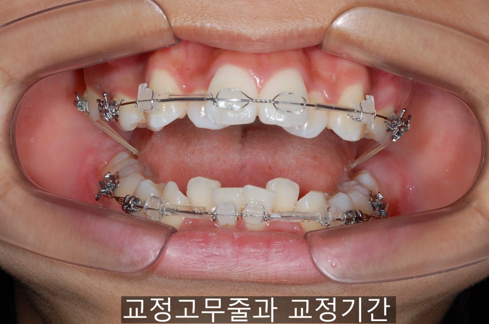 치아교정기간 짧아지는 방법 6가지! 관련 이미지 16
