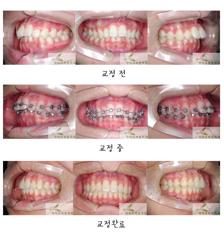 [토끼이빨교정후기] 토끼이빨교정은 나이가 어릴수록 교정기간은 짧아지고 비발치가능성은 높아지고... 관련 이미지 1