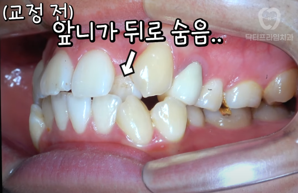 강남역 교정치과 :: 앞니 교정 시작 전에 꼭 알아야 할 한 가지 사실! 관련 이미지 1
