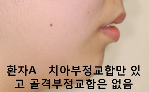 덧니와 주걱턱이 같이 있는 경우에 가장 효과적인 교정방법! 관련 이미지 7