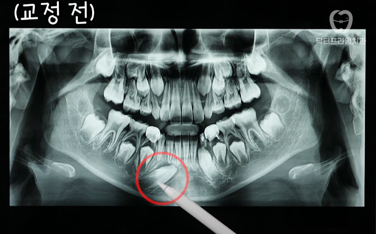 Facial asymmetry turns out to be caused by tooth alignment—can be improved with orthodontics! image 9
