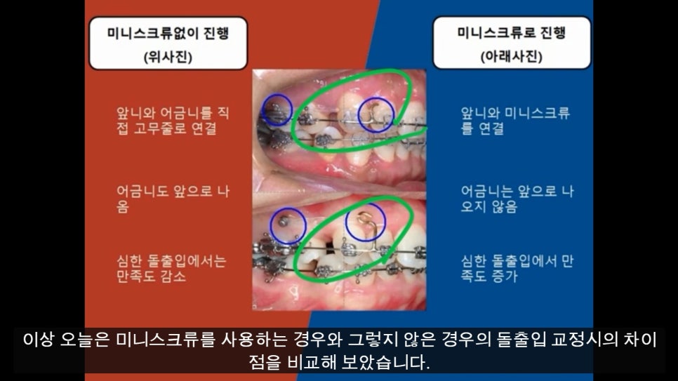 [치아교정]치아교정미니스크류비교설명.미니스크류사용방법! 관련 이미지 2
