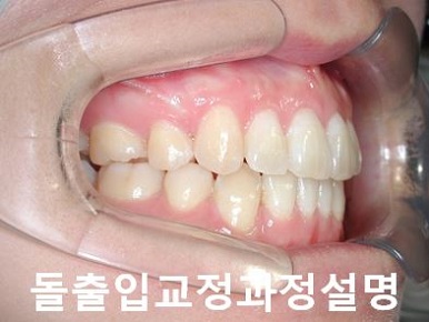 돌출입교정에 성공하는 방법 3가지! 관련 이미지 11