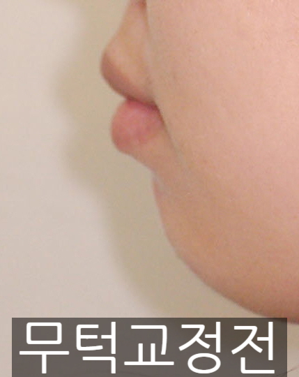 무턱수술했나요? 아니요, 무턱교정만 했어요! 관련 이미지 1