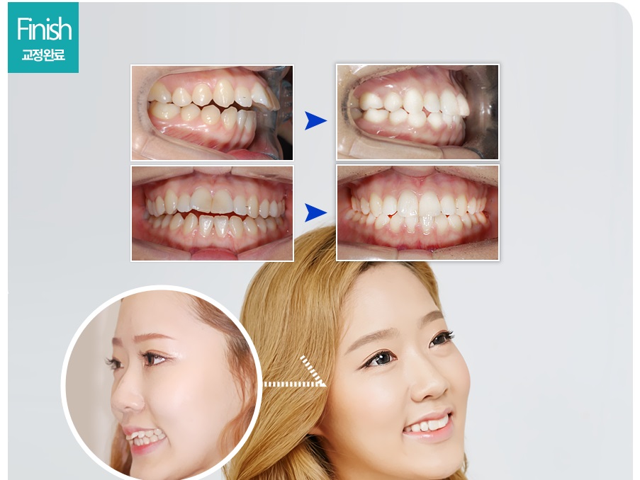 [돌출입교정전후] 앞니돌출교정사례 관련 이미지 6