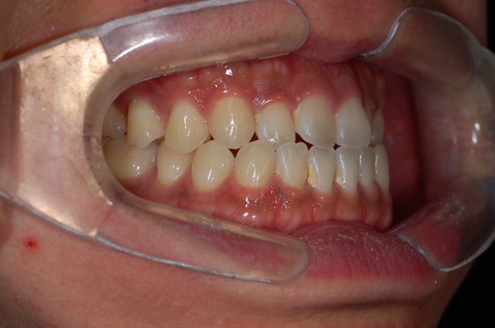 Can Braces Make the Lower Jaw Recede? When It’s Possible vs. When Surgery Is Needed image 3