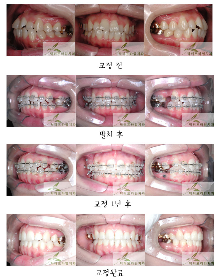 [치아교정후기] 앞니돌출과 고르지 않은 앞니교정전후 관련 이미지 1