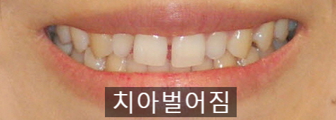 20세이상의 치아벌어짐, 교정 Vs 라미네이트! 관련 이미지 6