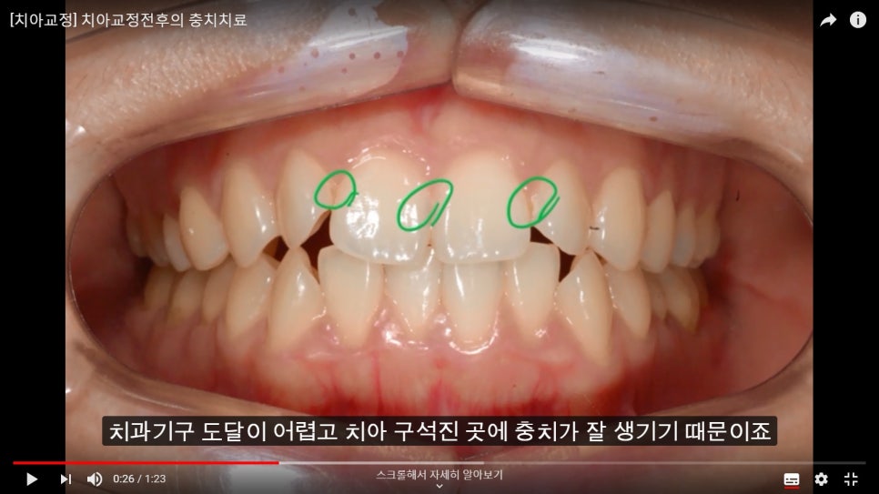 [치아교정]  치아교정전에 반드시 충치치료를 해야 하는가? 관련 이미지 1