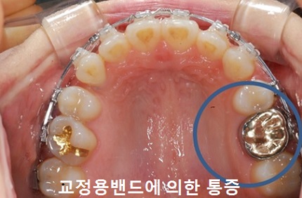 교정시작을 망설이게 하는 치아교정통증(2) 관련 이미지 9