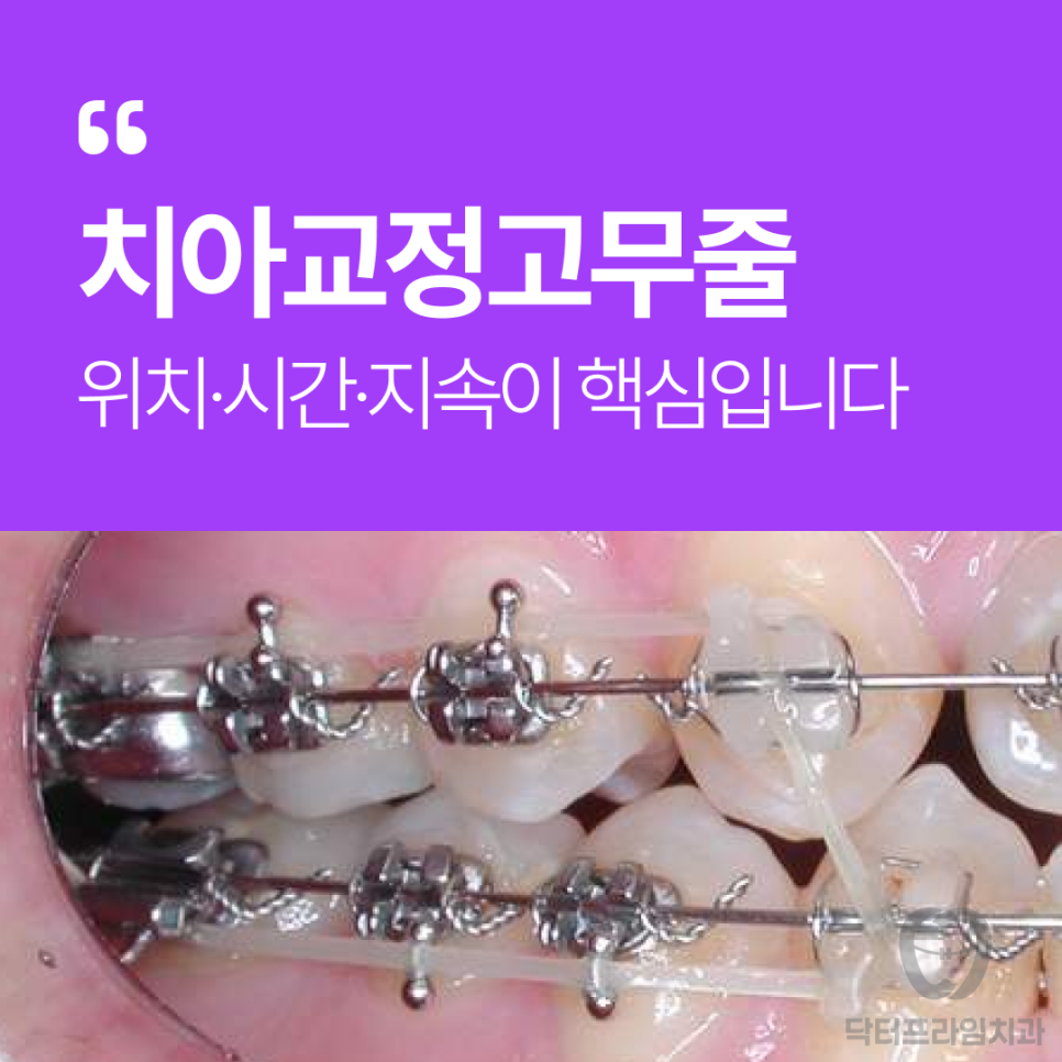 교정 고무줄, 그냥 끼는 게 아닙니다! 위치&middot;시간&middot;지속이 핵심입니다. 관련 이미지 1